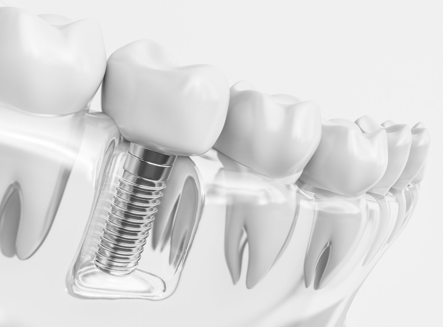 Implantat im transparent dargestellten Kieferknochen