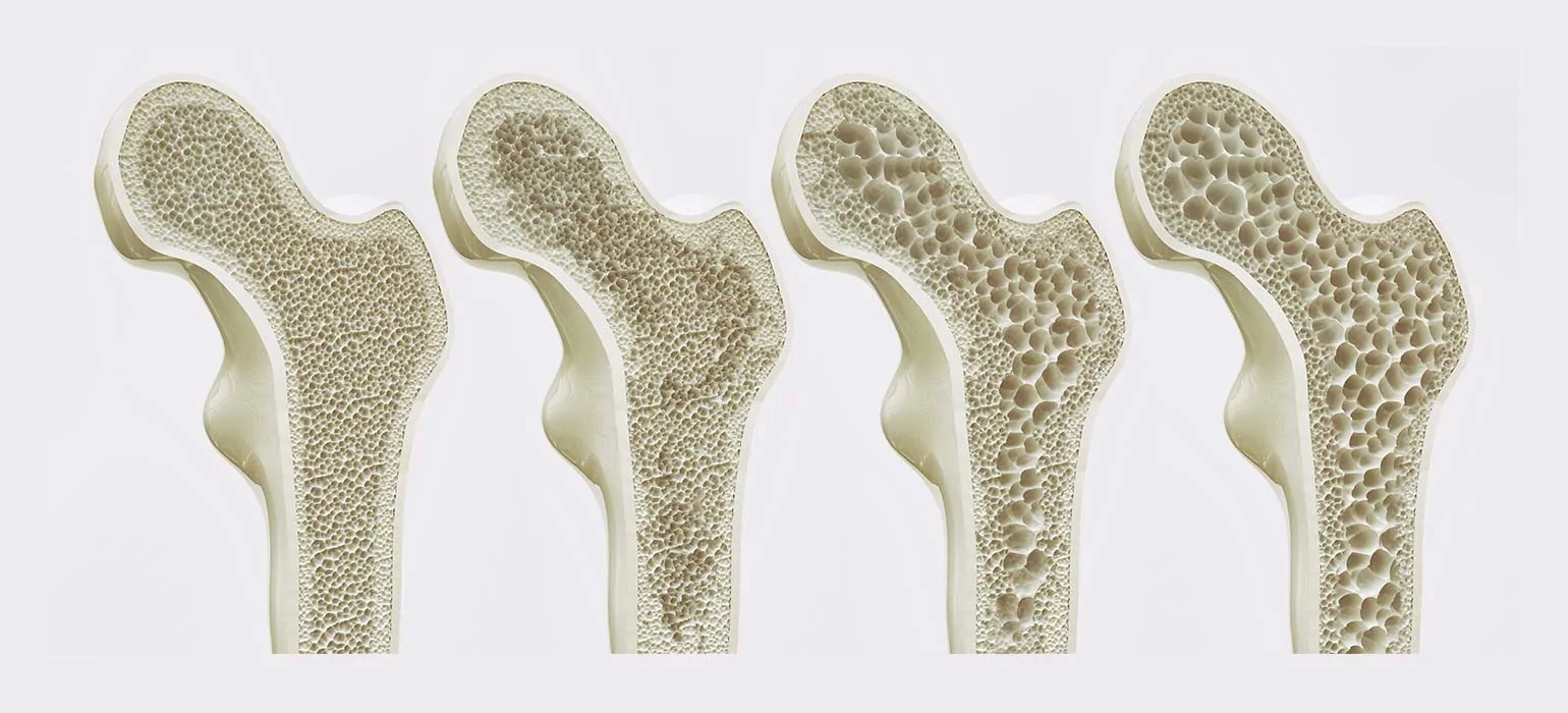 Osteoporose — Femurkopf-Stadien, veröffentlicht auf pflege.de