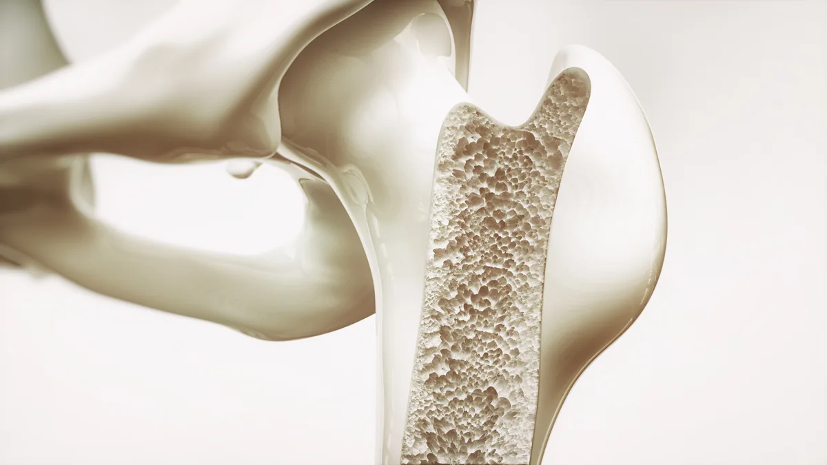Osteoporose — Knochendichteverlust-Stadium, veröffentlicht auf dieapotheke.com