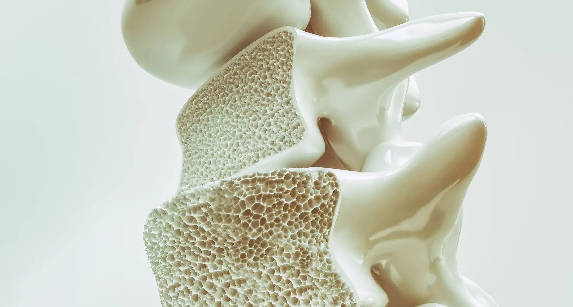 Osteoporose — Wirbelkörper-Anschnitt, veröffentlicht im Deutschen Ärzteblatt